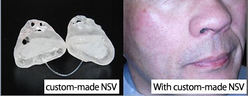 Custom-made NSV