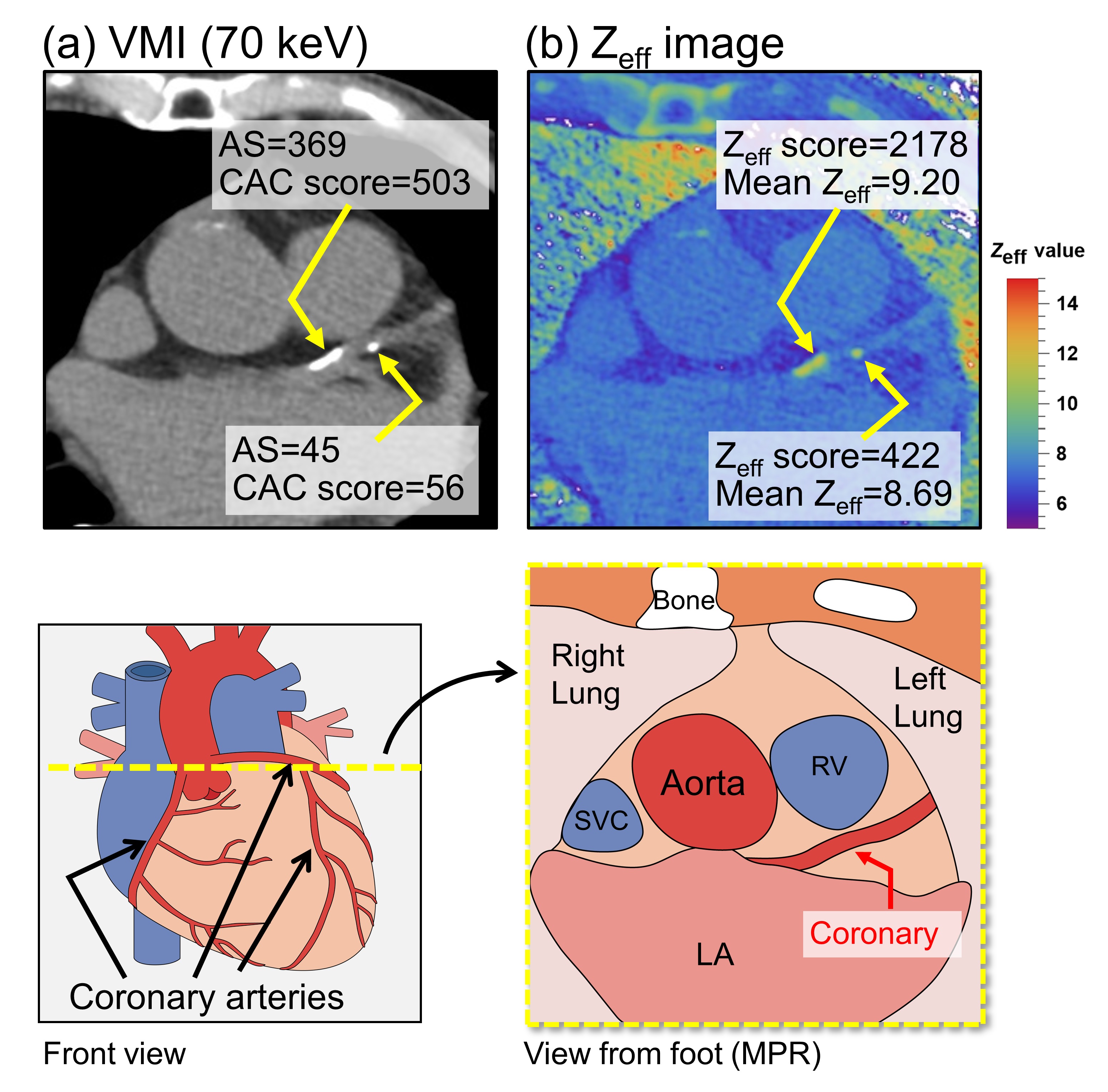Plaque CT images